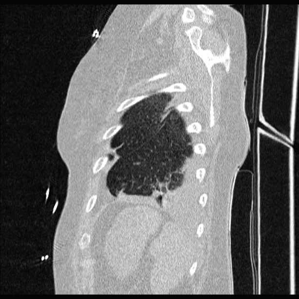 Cardiogenic pulmonary edema (Radiopaedia 29213-29609 Sagittal lung window 84).jpg