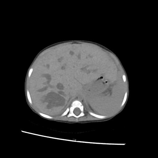 File:Caroli disease with autosomal recessive polycystic kidney disease (ARPKD) (Radiopaedia 89651-106703 Axial non-contrast 11).jpg