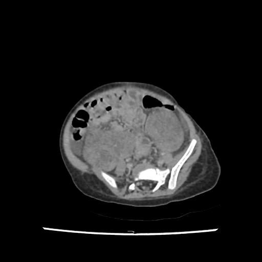 Caroli disease with autosomal recessive polycystic kidney disease (ARPKD) (Radiopaedia 89651-106703 B 169).jpg