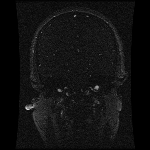 Carotid arterial dissection with acute cerebral infarction (Radiopaedia 26636-26784 MRV 92).jpg