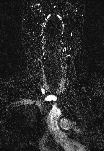Carotid artery dissection (Radiopaedia 28441-28689 Coronal MRA 21).jpg