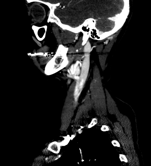 File:Carotid body tumor (Radiopaedia 39845-42300 D 5).jpg