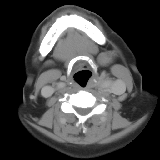 Carotid body tumor (paraganglioma) (Radiopaedia 38586-40729 A 56).jpg