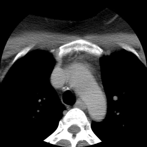 Carotid body tumor (paraganglioma) (Radiopaedia 38586-40729 A 72).jpg
