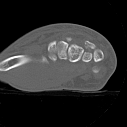 File:Carpo-metacarpal fracture-dislocations with hamatum split fracture (Radiopaedia 18482-18343 Axial bone window 19).jpg