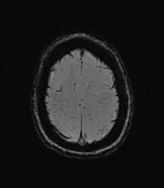 File:Cavernoma with bleed - midbrain (Radiopaedia 54546-60773 Axial SWI 41).png