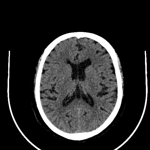 Cavernous hemangioma of the cerebellar falx (Radiopaedia 73025-83723 Axial non-contrast 80).jpg