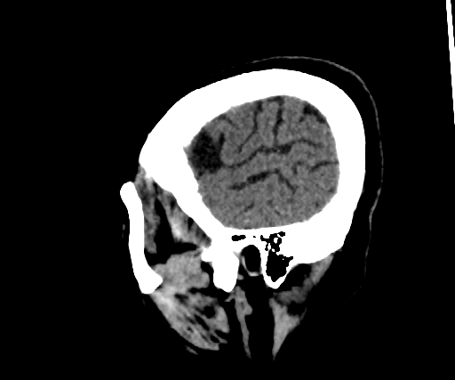 Cavernous hemangioma of the cerebellar falx (Radiopaedia 73025-83723 B 283).jpg