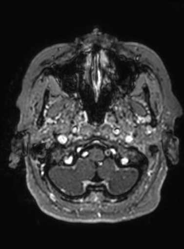 Cavernous hemangioma of the cerebellar falx (Radiopaedia 73025-83724 Axial T1 C+ 308).jpg