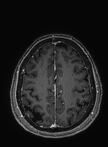 File:Cavernous hemangioma of the cerebellar falx (Radiopaedia 73025-83724 Axial T1 C+ 89).jpg