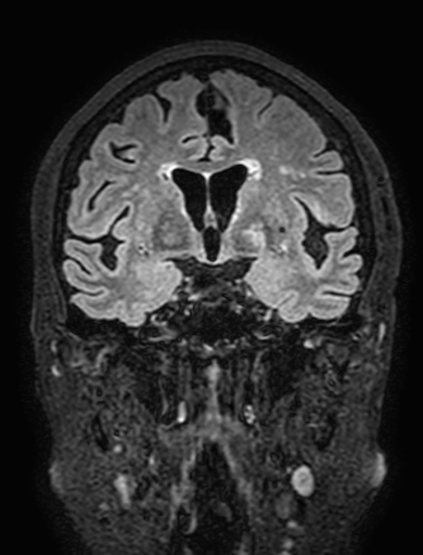 Cavernous hemangioma of the cerebellar falx (Radiopaedia 73025-83724 Coronal FLAIR 151).jpg