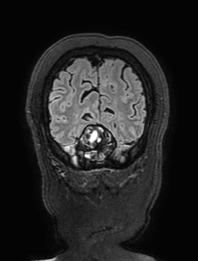 Cavernous hemangioma of the cerebellar falx (Radiopaedia 73025-83724 Coronal FLAIR 317).jpg