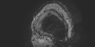 Cavernous hemangioma of the cerebellar falx (Radiopaedia 73025-83724 Sagittal BOLD 1).jpg