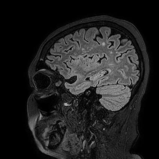 File:Cavernous hemangioma of the cerebellar falx (Radiopaedia 73025-83724 Sagittal FLAIR 50).jpg