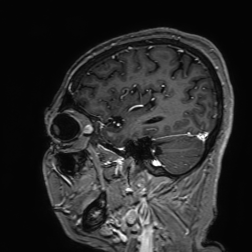 Cavernous hemangioma of the cerebellar falx (Radiopaedia 73025-83724 Sagittal T1 C+ 50).jpg