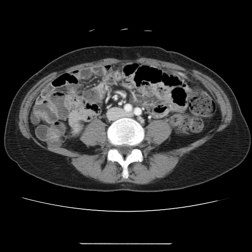 Cavernous hepatic hemangioma (Radiopaedia 75441-86667 B 69).jpg