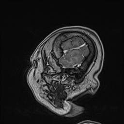 Cavernous sinus meningioma (Radiopaedia 63682-72367 Sagittal T1 C+ 150).jpg
