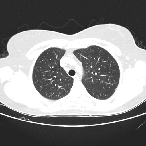 File:Cavitating lung mass - squamous cell carcinoma (Radiopaedia 48047-52854 Axial lung window 14).png