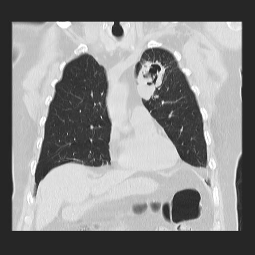 File:Cavitating pulmonary metastases (Radiopaedia 89545-106544 Coronal lung window 13).jpg