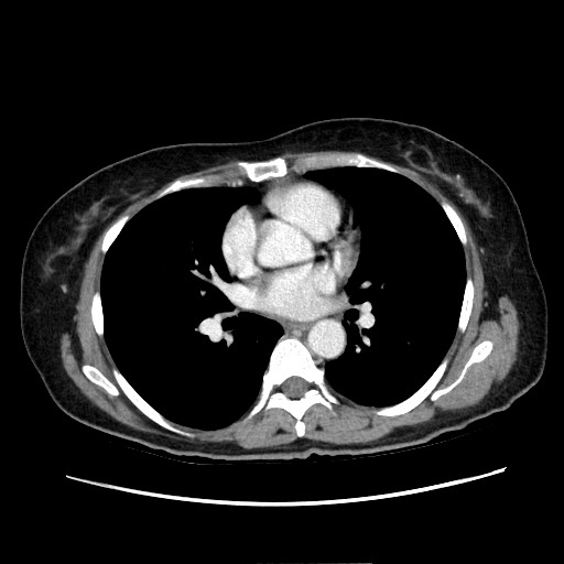 Cecal adenocarcinoma (Radiopaedia 75909-87331 A 2).jpg