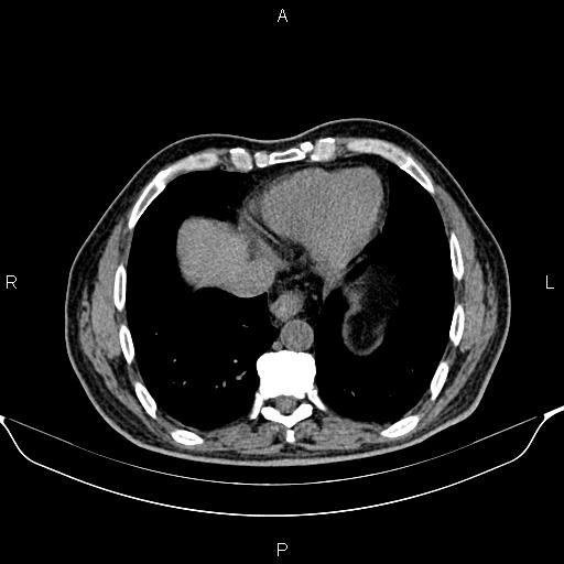Cecal adenocarcinoma (Radiopaedia 85324-100916 Axial non-contrast 7).jpg