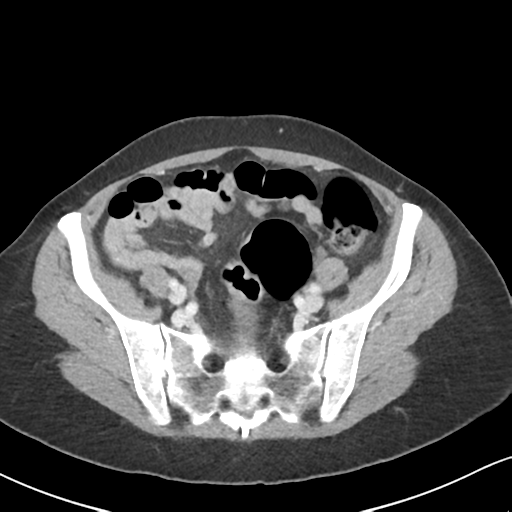 Cecal internal hernia through the foramen of Winslow (Radiopaedia 44820-48651 B 58).png
