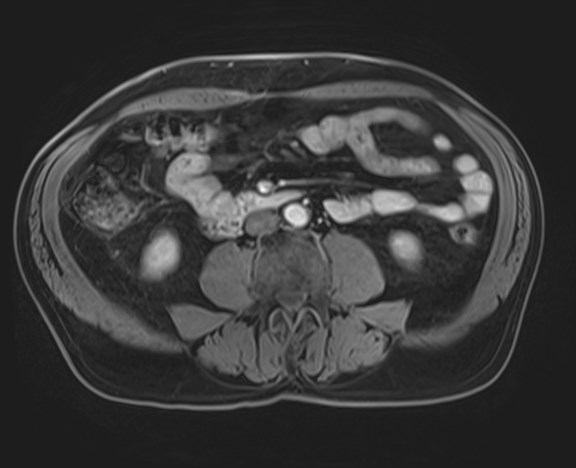 File:Cecal mass causing appendicitis (Radiopaedia 59207-66532 H 78).jpg