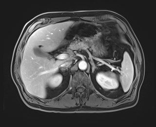Cecal mass causing appendicitis (Radiopaedia 59207-66532 T1 C+ PV phase 44).jpg