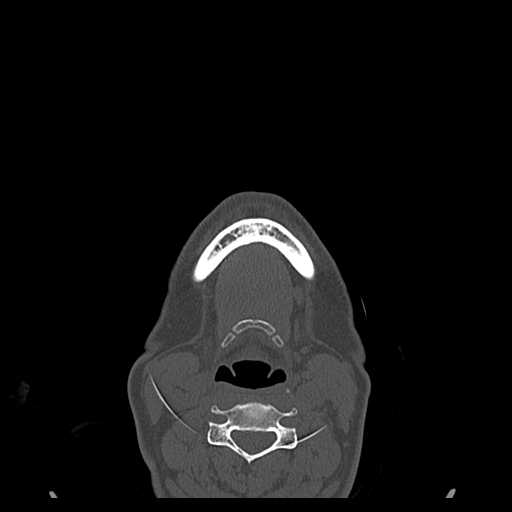 File:Cemento-ossifying fibroma (Radiopaedia 21243-21149 Axial bone window 15).jpg