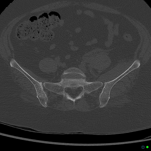 Central fracture-dislocation of the acetabulum (Radiopaedia 36578-38150 Axial bone window 8).jpg