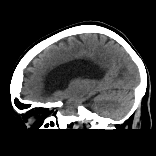 File:Central neurocytoma (Radiopaedia 65317-74346 C 22).png