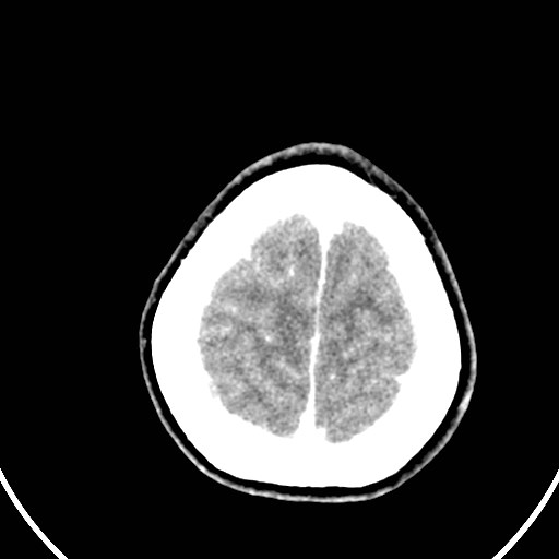 Central neurocytoma (Radiopaedia 84497-99871 B 45).jpg