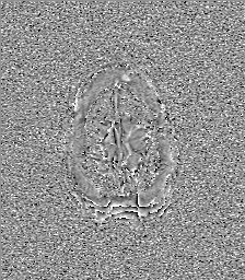Central neurocytoma (Radiopaedia 84497-99872 Axial 68).jpg