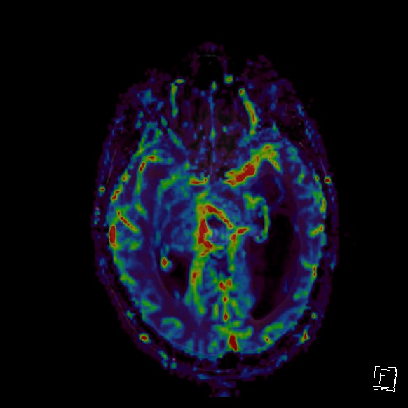 Central neurocytoma (Radiopaedia 84497-99872 Axial Perfusion 184).jpg