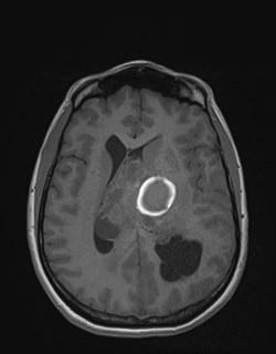 Central neurocytoma (Radiopaedia 84497-99872 Axial T1 118).jpg