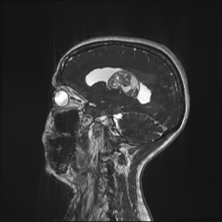 File:Central neurocytoma (Radiopaedia 84497-99872 Sagittal CISS 19).jpg