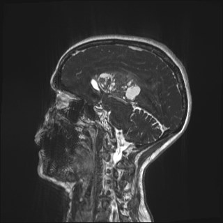 Central neurocytoma (Radiopaedia 84497-99872 Sagittal CISS 31).jpg
