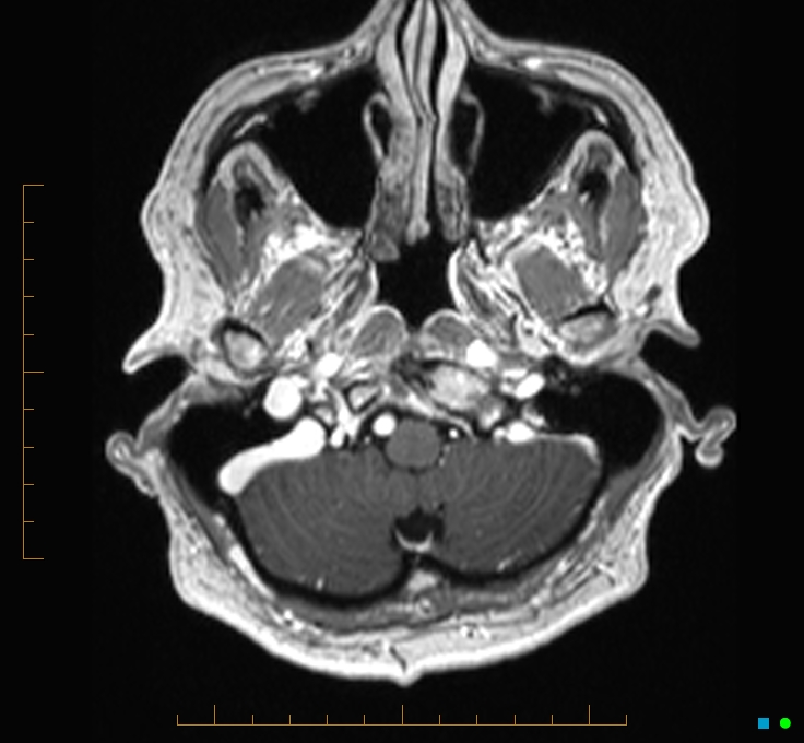 Cerebellar gangliocytoma (Radiopaedia 65377-74422 Axial T1 C+ 6).jpg