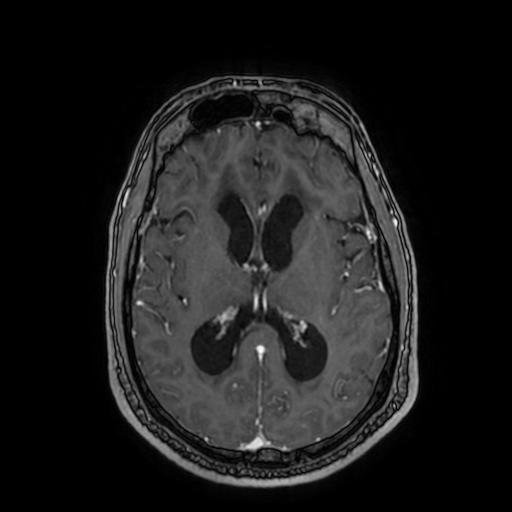 Cerebellar hemangioblastoma (Radiopaedia 88055-104622 Axial T1 C+ 100).jpg
