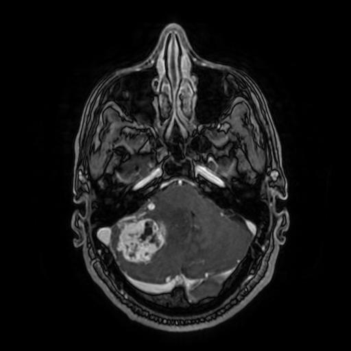 Cerebellar hemangioblastoma (Radiopaedia 88055-104622 Axial T1 C+ 55).jpg