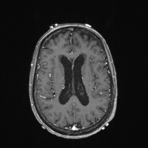 Cerebellar metastases (Radiopaedia 24038-24249 Axial T1 C+ 7).jpg