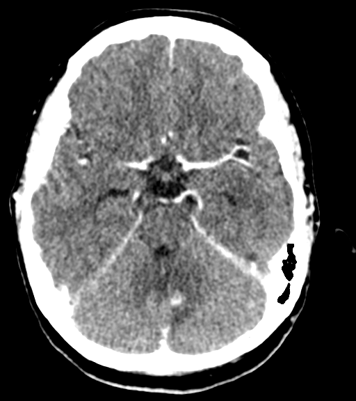 Cerebellar metastases - colorectal adenocarcinoma (Radiopaedia 40947-43652 Axial C+ 19).png