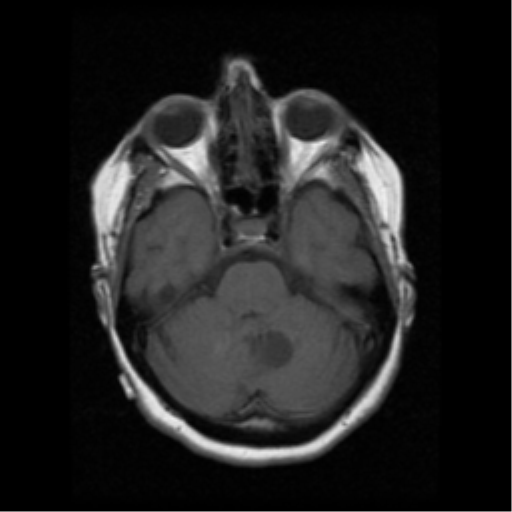 File:Cerebellar metastasis (cystic appearance) (Radiopaedia 41395-44262 Axial T1 7).png