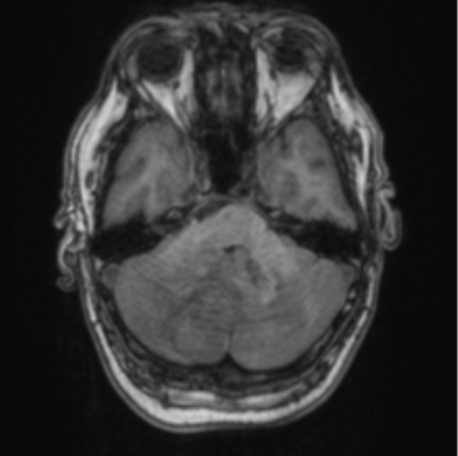Cerebellar metastasis from lung adenocarcinoma (Radiopaedia 86690-102829 Axial T1 24).png