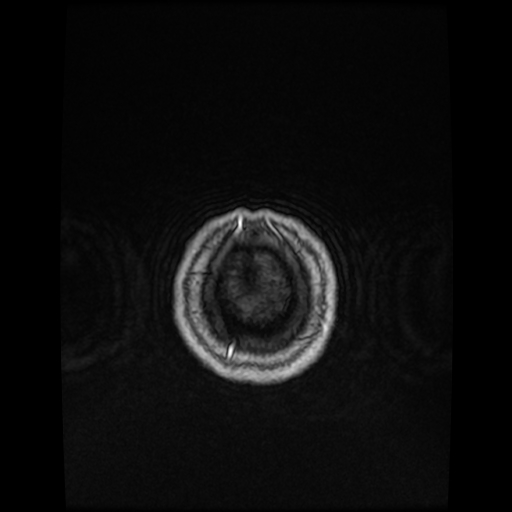 Cerebellar metastasis of pulmonary adenocarcinoma, cavernous venous malformation, and developmental venous anomaly (Radiopaedia 85827-101661 Axial T1 C+ 88).jpg