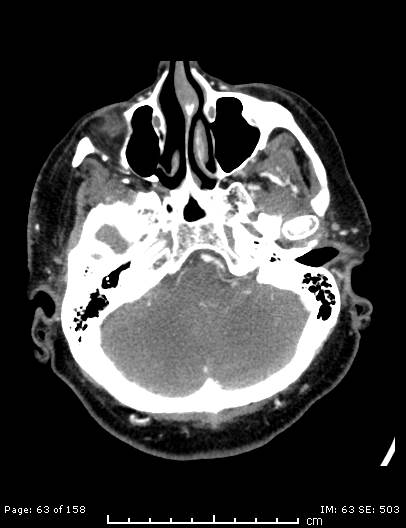 File:Cerebellar strokes due to intracranial giant cell arteritis (Radiopaedia 68799-78510 CT angiogram 63).jpg