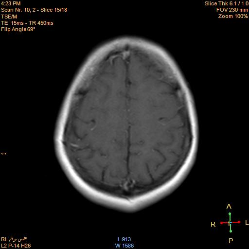 File:Cerebellopontine angle meningioma (Radiopaedia 22488-22525 Axial T1 C+ 14).jpg