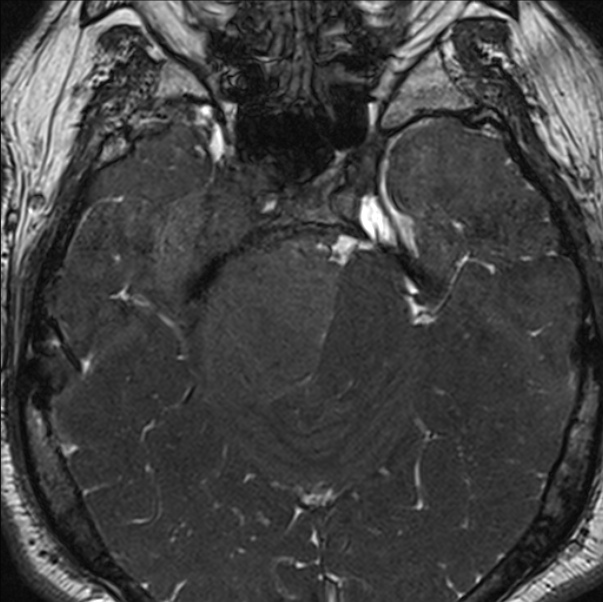 Cerebellopontine angle meningioma (Radiopaedia 24459-24764 I 29).jpg