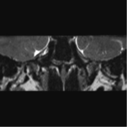 Cerebellopontine angle meningioma (Radiopaedia 48434-53348 Coronal T2 70).png