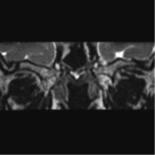 Cerebellopontine angle meningioma (Radiopaedia 48434-53348 Coronal T2 84).png